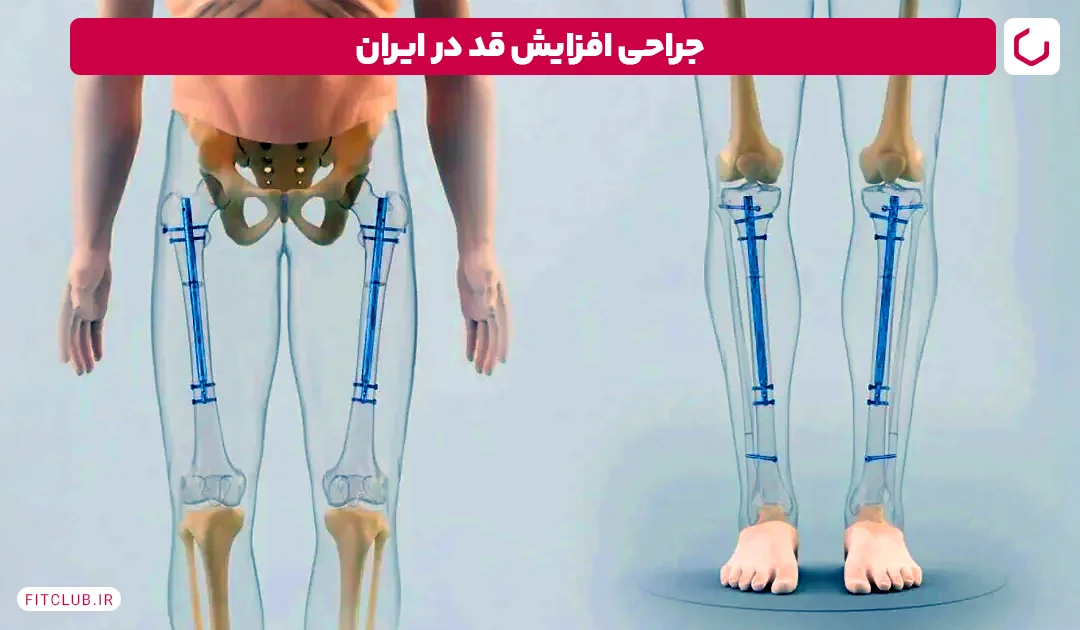 جراحی افزایش قد در ایران| فیت کلاب