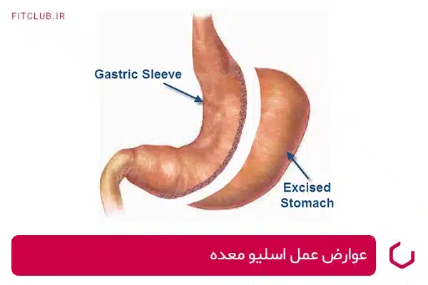 اثرات جانبی عمل اسلیو معده