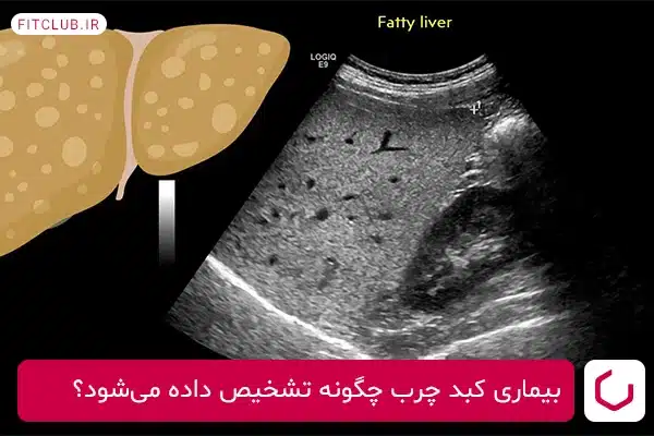 چگونگی تشخیص بیماری خاموش کبد چرب